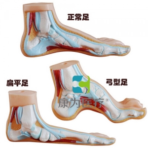 “康為醫(yī)療”正常足、扁平足、弓型足模型