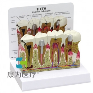 “康為醫(yī)療”醫(yī)患關系溝通模型-前磨牙和臼齒放大模型（醫(yī)學指導模型）