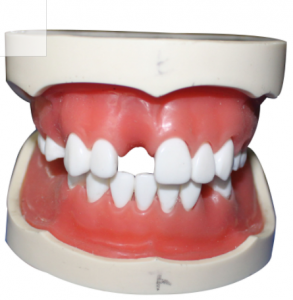 種植牙模型（含上、下頜）